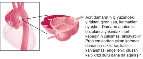 Aort damarı vücudunuzdaki saatli bomba'